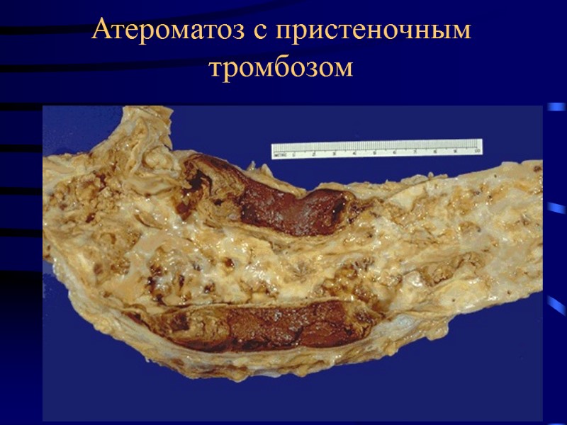 Атероматоз с пристеночным тромбозом